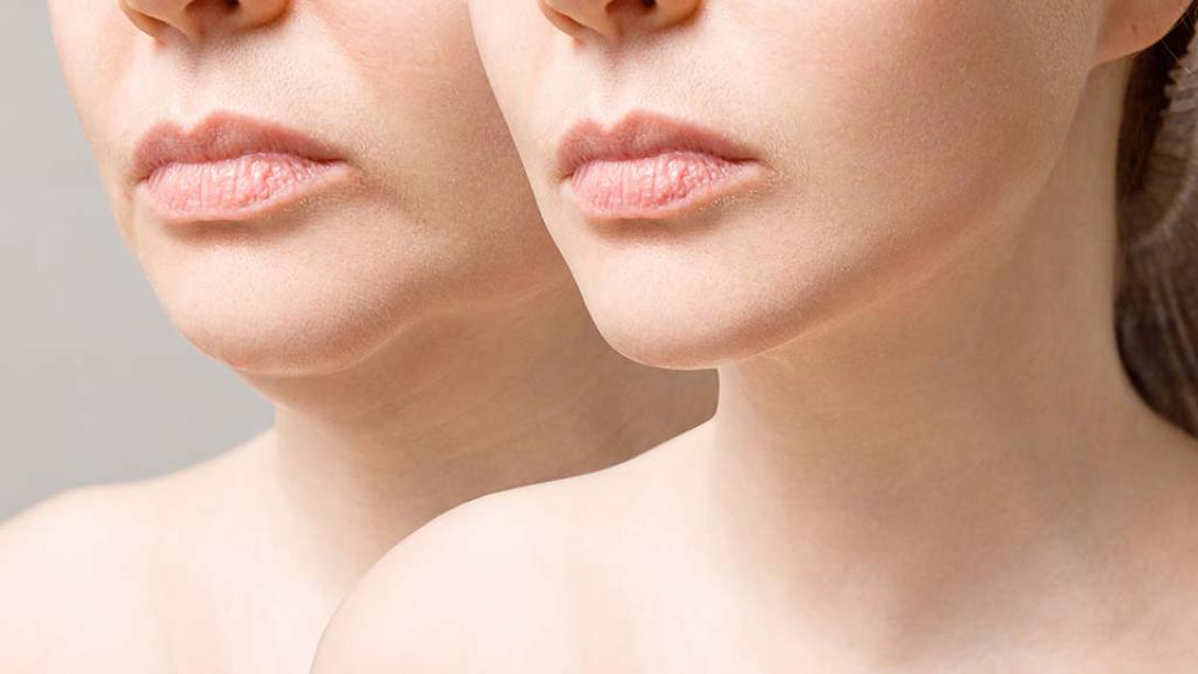 The Cosmetic Promise of Dermal Fillers