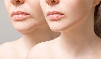The Cosmetic Promise of Dermal Fillers cover image