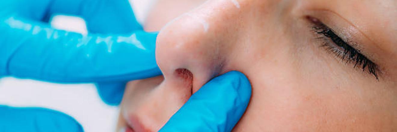 Cover image for Rhinoplasty