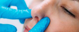 Cover image for Rhinoplasty
